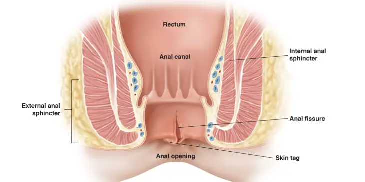 Anal Fissure Treatment in Anna Nagar