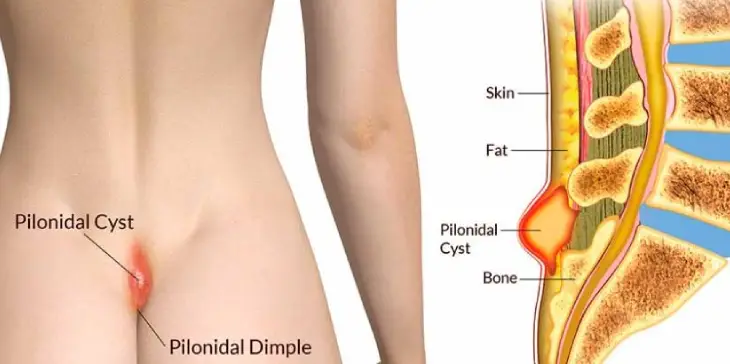 Pilonidal Sinus